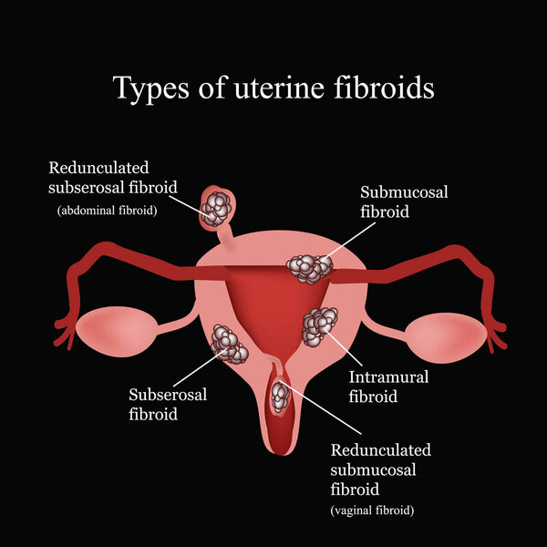 Types of uterine fibroids. Endometriosis. Infographics. Vector illustration on a black background
