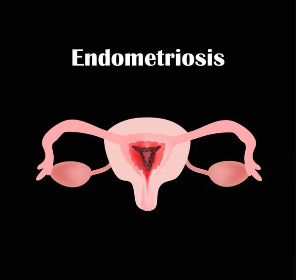 Endometriose. A estrutura dos órgãos pélvicos. Adenomiose. O endométrio. Ilustração vetorial —  Vetores de Stock