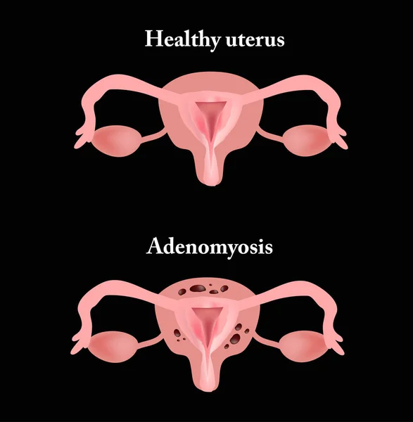 Endometriose. A estrutura dos órgãos pélvicos. Adenomiose. O endométrio. Ilustração vetorial — Vetor de Stock