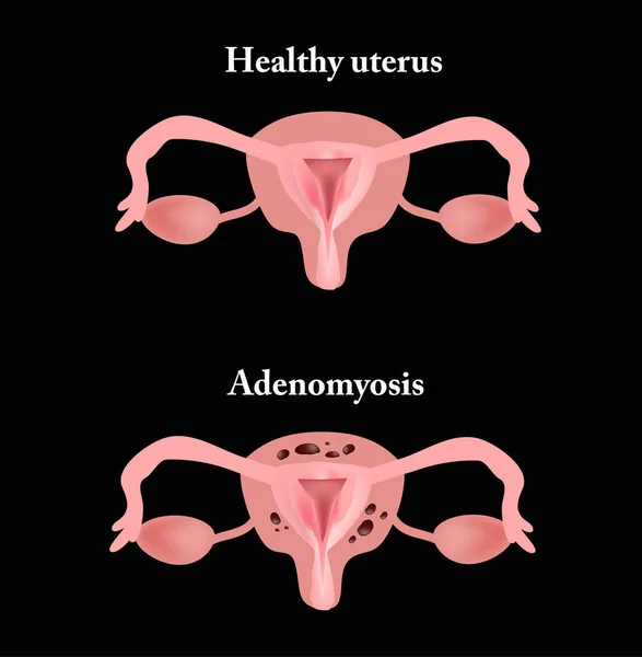 Endometriosis. La estructura de los órganos pélvicos. Adenomiosis. El endometrio. Ilustración vectorial — Archivo Imágenes Vectoriales