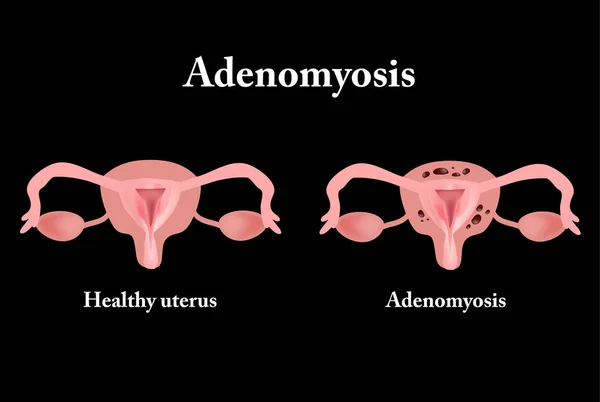Endometrióza. Struktura pánevních orgánů. Adenomyosis. Endometrium. Vektorové ilustrace — Stockový vektor