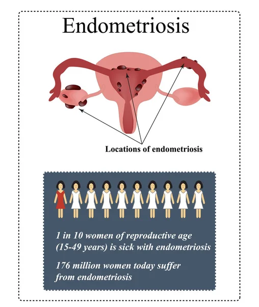 Endometrióza. Endomezkušební cysty. Vektorová ilustrace na izolovaném — Stockový vektor