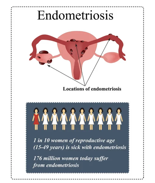 Endométriose. Kystes endométriaux. Illustration vectorielle sur isolée — Image vectorielle