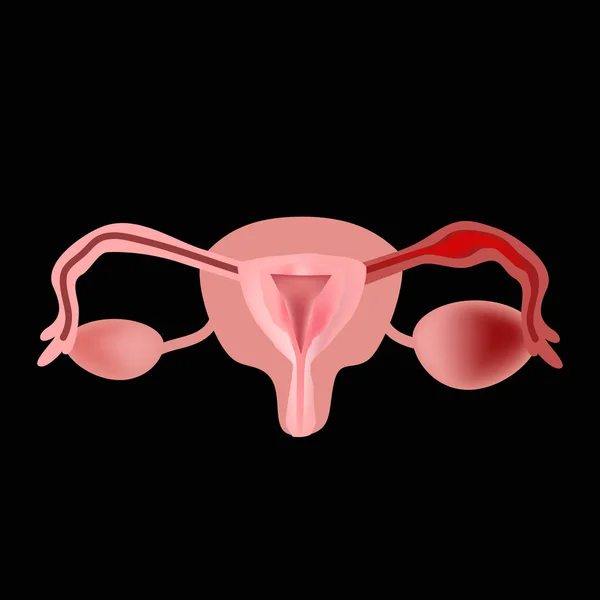 Salpingit. Inflammation i äggledaren. Endometrit. äggstockarna. bäckenorgan. Illustration av Infographics Vector — Stock vektor