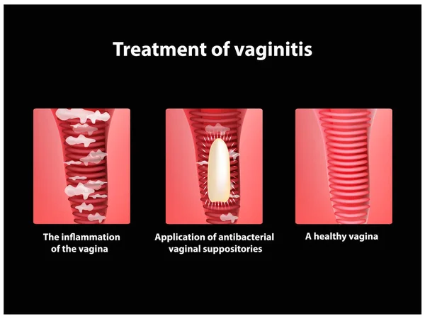 Traitement des suppositoires vaginaux. inflammation du vagin. Infographie. illustration vectorielle — Image vectorielle