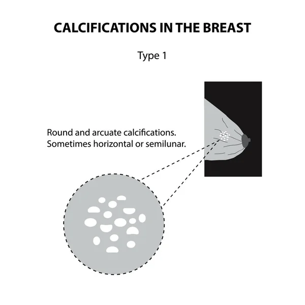 乳房の石灰化。マンモグラフィ。乳腺。インフォ グラフィック。孤立した背景のベクトル図 — ストックベクタ