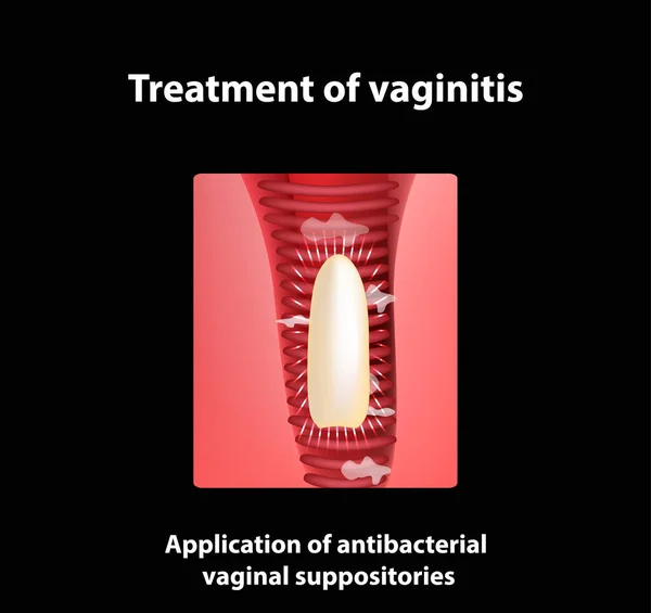 Tratamiento de supositorios de vaginitis. inflamación la vagina. Infografías. ilustración vectorial — Vector de stock