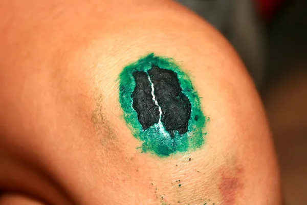 Healing wound on the knee. The wound treated with brilliant green. The scab will climb