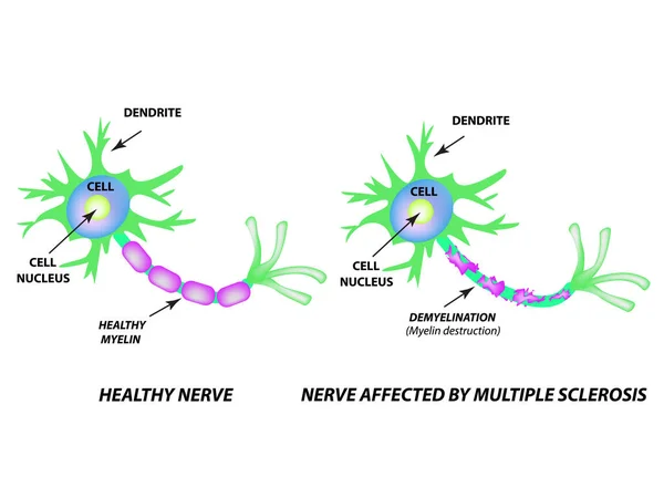 A destruição da bainha de mielina no axônio. Mielina danificada. Neuron afetado pela esclerose múltipla. Dia Mundial da esclerose múltipla. Infográficos. Ilustração vetorial sobre fundo isolado . — Vetor de Stock