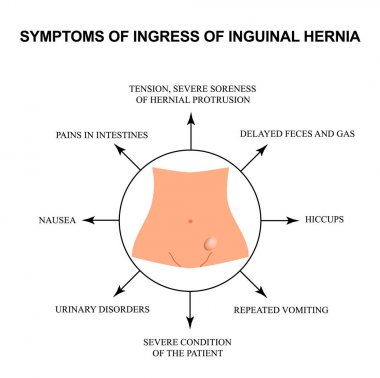 Bozulmuş inguinal fıtık belirtileri. ınfographics. Yalıtılmış arka planda vektör çizimi.