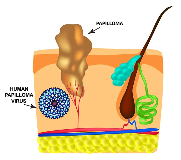 Humaan papillomavirus veroorzaakt de vorming van papillomas op de huid. Structuur. Infographics. Vector illustratie op geïsoleerde achtergrond. — Stockvector
