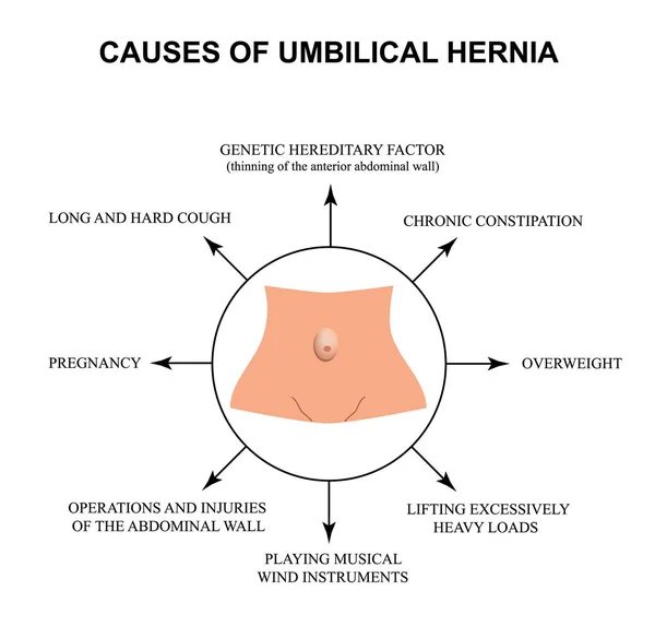 Causas de la hernia umbilical. Infografías. Ilustración vectorial sobre fondo aislado . — Vector de stock