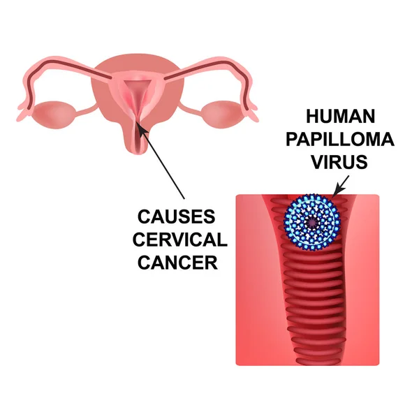 Virus del papilloma umano. Causa il cancro al collo dell'utero. La struttura degli organi pelvici. Infografica. Illustrazione vettoriale su sfondo isolato . — Vettoriale Stock