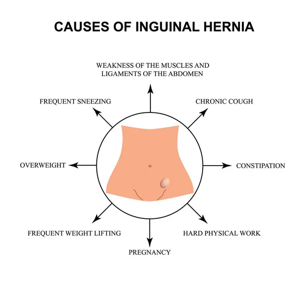 Causas de la hernia inguinal. Infografías. Ilustración vectorial sobre fondo aislado . — Vector de stock