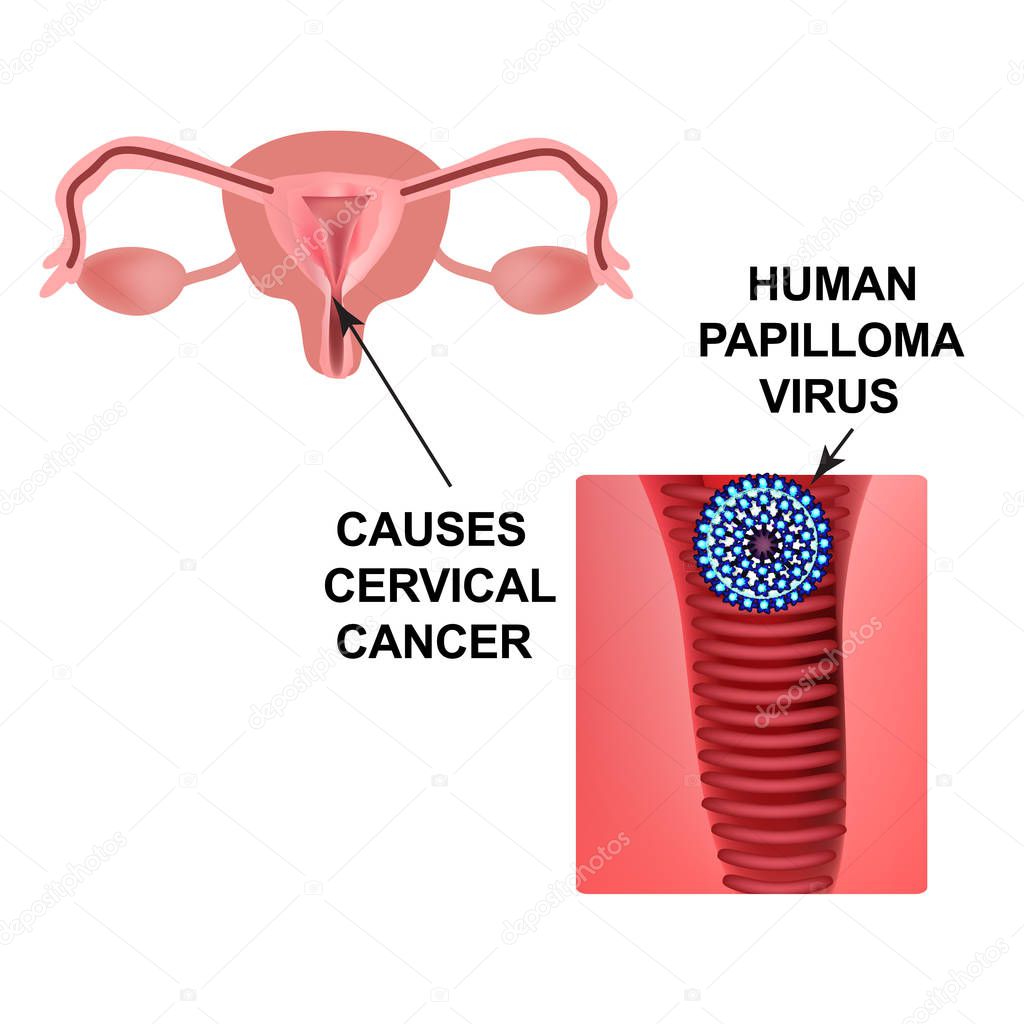 Human Papilloma Virus. Causes cervical cancer. The structure of the pelvic organs. Infographics. Vector illustration on isolated background.