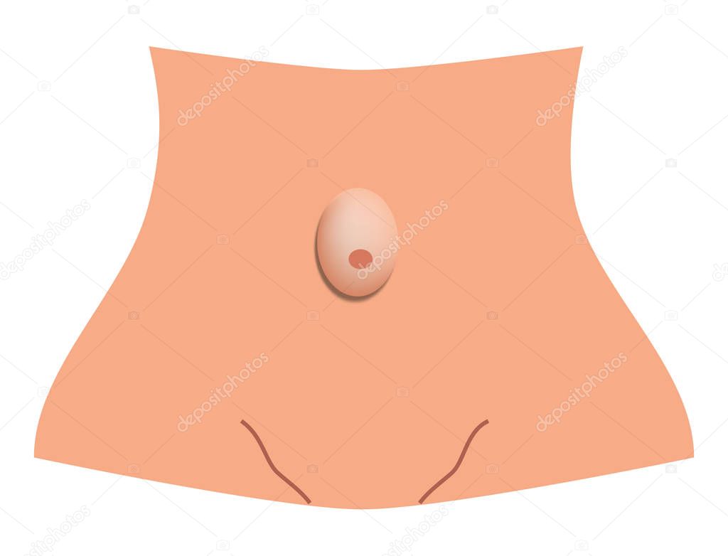 Umbilical hernia. intestinal hernia. Infographics. Vector illustration on isolated background.
