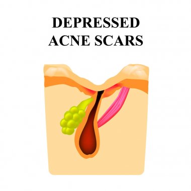 Akne izi. Derinin yapısı. Kırışıklık. ınfographics. Yalıtılmış arka planda vektör çizimi.