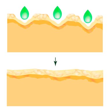 Genişlemiş gözenekler. Derinin yapısı. Kırışıklıklar, akne izi. Gözenekleri temizlemek ve daraltma. ınfographics. Yalıtılmış arka planda vektör çizimi.