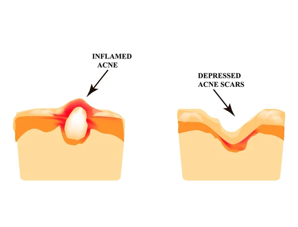 Acné inflamado en la piel. Espinilla inflamada. La estructura de la piel. Cicatriz de acné. Infografías. Ilustración vectorial sobre fondo aislado . — Vector de stock