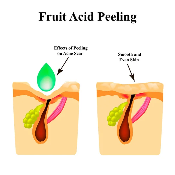 Zapalenie trądzik na skórze. Zapał pryszcz. Trądzik blizny. Zabieg peeling kwasowy. Struktura skóry. Zmarszczki. Infografiki. Ilustracja wektorowa na białym tle. — Wektor stockowy