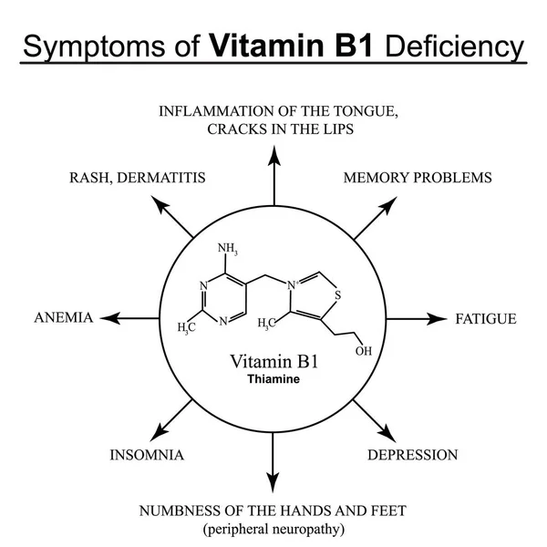 Sintomi di carenza di vitamina B1. Infografica. Illustrazione vettoriale su uno sfondo isolato . — Vettoriale Stock