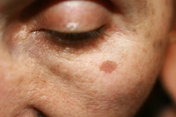 Pigmentación en la cara. Mancha marrón en la mejilla. Mancha de pigmento en la piel . — Foto de Stock