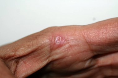 Elinde mısır var. Deride yara.