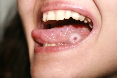 Amphotoid stomatitis. Candidiasis of the tongue. Ulcer on the tongue. Candida fungus. clipart