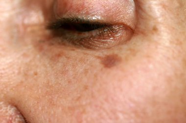 Pigmentasyon yüzünde. Brown yanak üzerinde spot. Pigment cilt üzerinde spot.