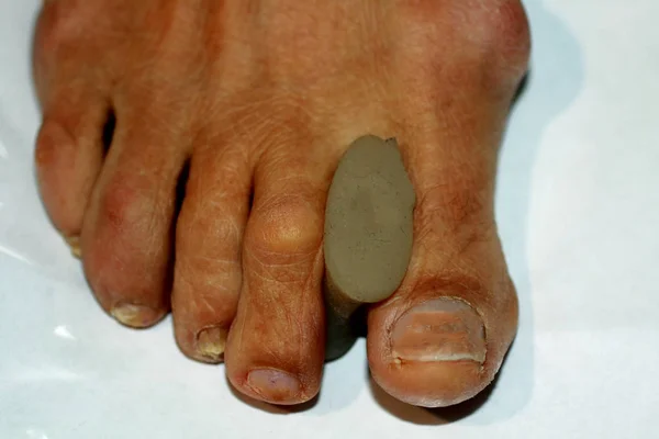 Коррекция кривизны пальца ноги — стоковое фото