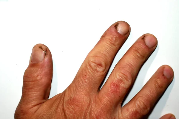 Grieta en el pulgar. Rebabas y suciedad en la piel. La mano del trabajador — Foto de Stock