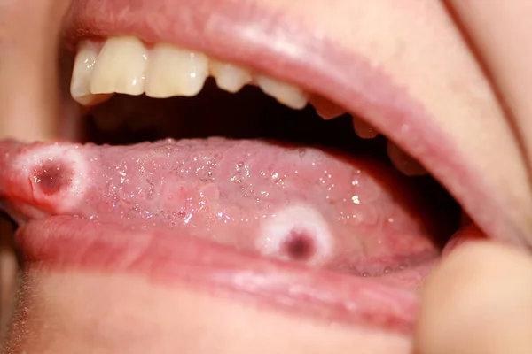 Amphotoid stomatitis. Candidiasis of the tongue. Ulcer on the tongue. Candida fungus. — Stock Photo, Image