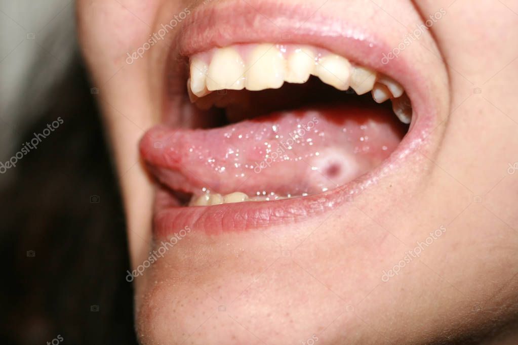Estomatitis amfotoide. Candidiasis de la lengua. Úlcera en la lengua