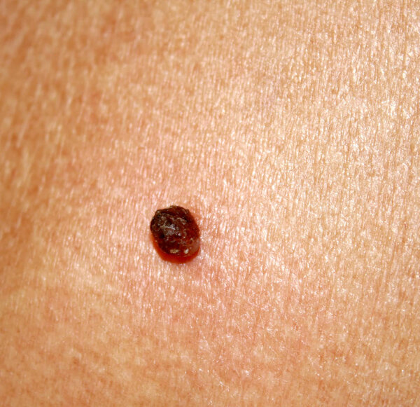 Birthmark on the skin Papiloma on the body