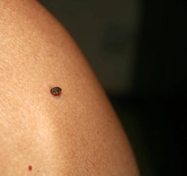 Marca de nascença na pele Papiloma no corpo — Fotografia de Stock