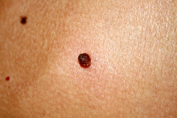 Birthmark on the skin Papiloma on the body — Stock Photo, Image