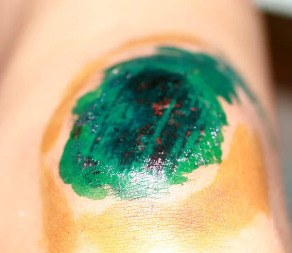 Healing wound on the knee. The wound treated with brilliant green. The scab will climb