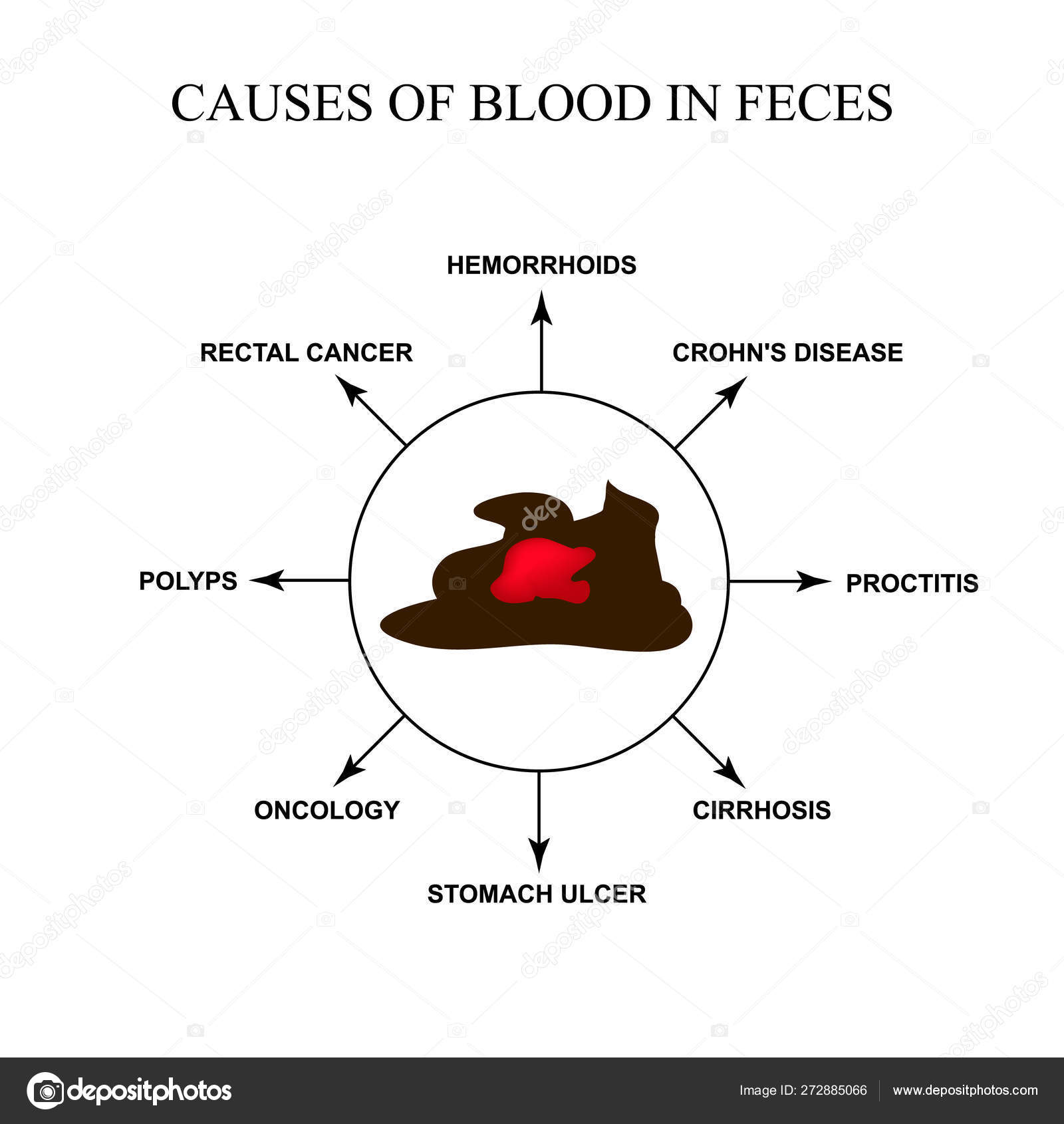 Image vectorielle Causes du sang dans les selles. Maladies du tube ...