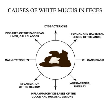 Causes of white mucus in feces. Diseases of the gastrointestinal tract. Infographics. Vector illustration on isolated background. clipart