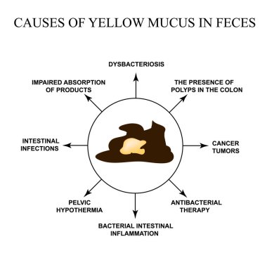 Causes of yellow mucus in feces. Diseases of the gastrointestinal tract. Infographics. Vector illustration on isolated background. clipart