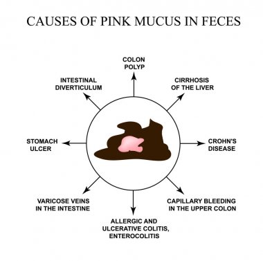 Causes of pink mucus in feces. Diseases of the gastrointestinal tract. Infographics. Vector illustration on isolated background. clipart