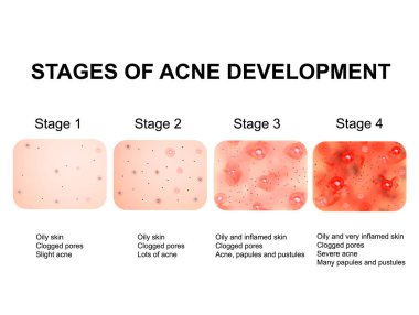 Stages of development of acne. Inflamed skin with scars, acne and pimples. The texture of inflamed skin, and acne and pimples. Infographics. Vector illustration. clipart