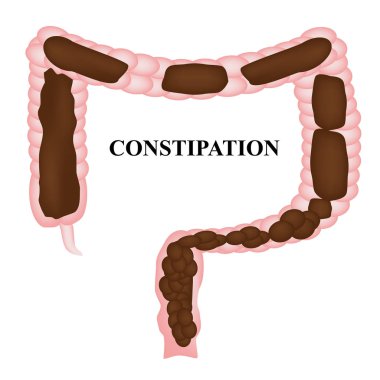 Constipation. Feces in colon. Infographics. Vector illustration on isolated background. clipart