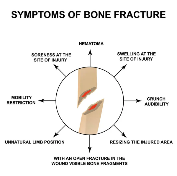 Síntomas de fractura ósea. Fractura ósea con desplazamiento. Infografías. Ilustración vectorial sobre fondo aislado . — Vector de stock