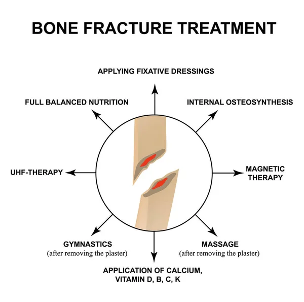 Tratamento de fracturas ósseas. Fratura óssea com deslocamento. Infográficos. Ilustração vetorial sobre fundo isolado . —  Vetores de Stock