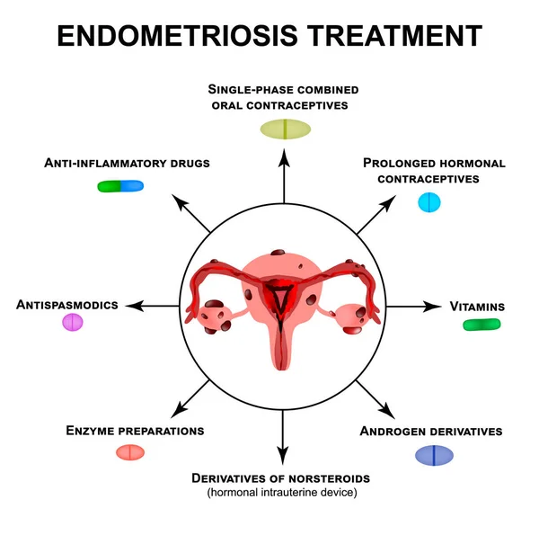 Tratamento da endometriose. Adenomiose. Estrutura dos órgãos pélvicos com endometriose. Infográficos. Ilustração vetorial sobre fundo isolado . —  Vetores de Stock