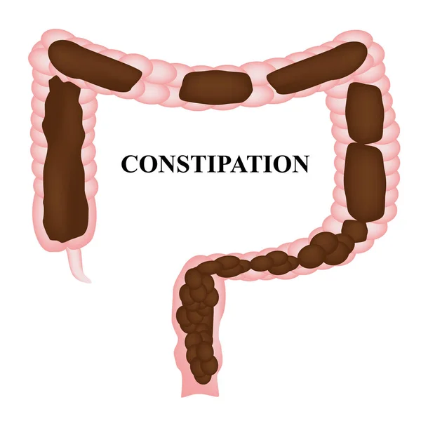 Constipatie. Ontlasting in Colon. Infographics. Vector illustratie op geïsoleerde achtergrond. — Stockvector