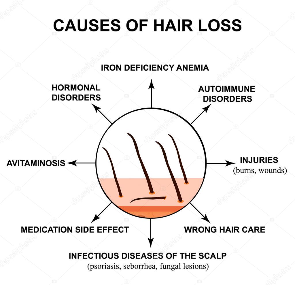 Causes of hair loss. The structure of the skin and hair. Infographics. Vector illustration on isolated background.