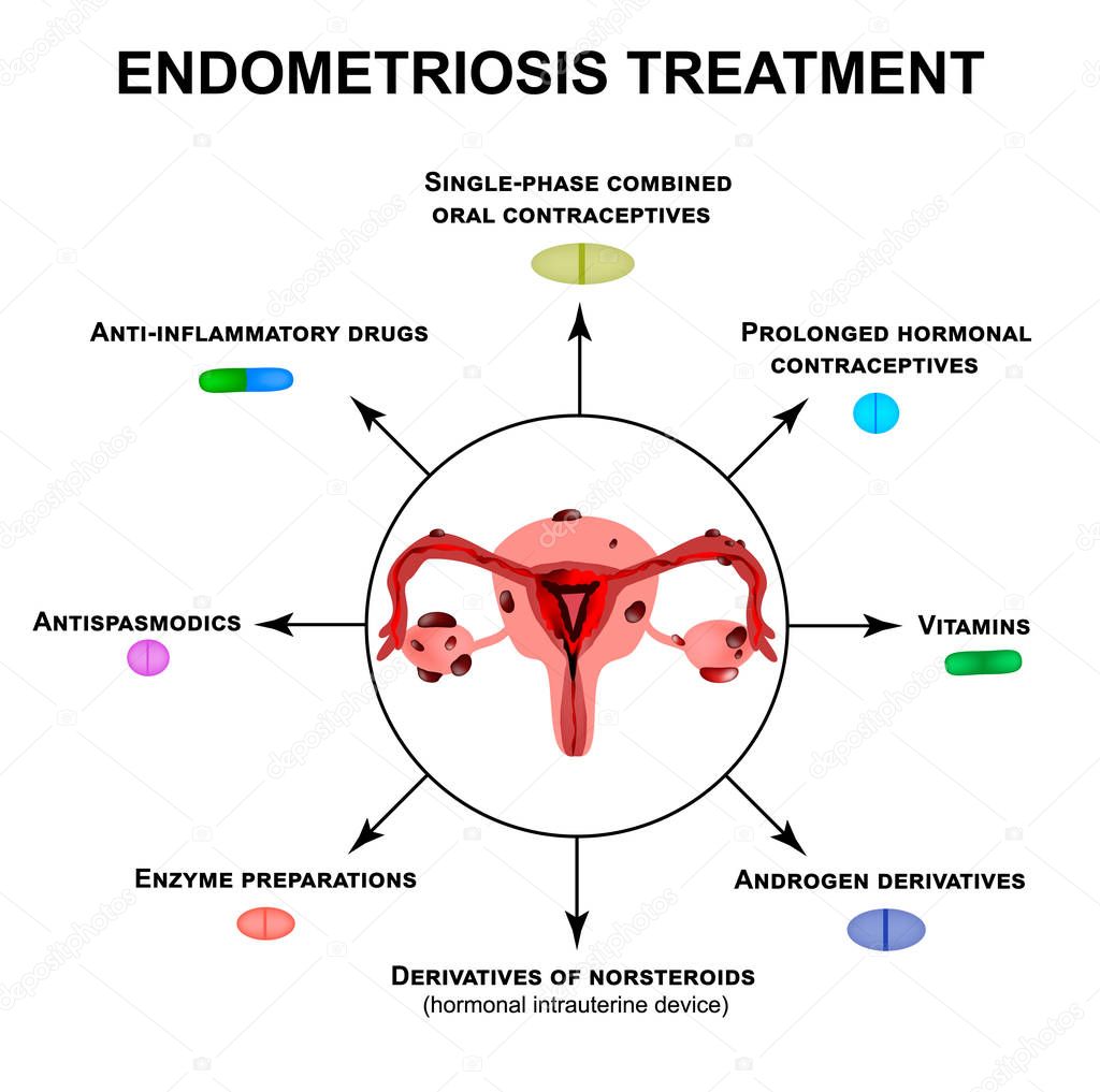 Treatment of endometriosis. Adenomyosis. The structure of the pelvic organs with endometriosis. Infographics. Vector illustration on isolated background.