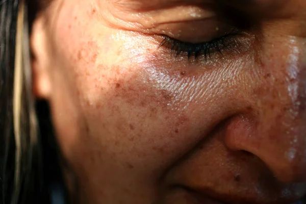 Manchas pigmentadas en la cara. Pigmentación en las mejillas — Foto de Stock